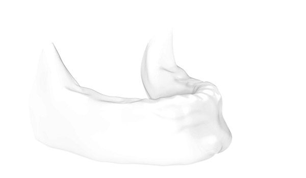 3D-Röntgenbild eines zahnlosen Kiefers