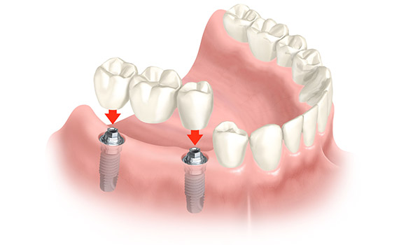 Animation einer implantatgetragenen Brücke, mit der größere zahnlose Bereiche wieder geschlossen werden können.