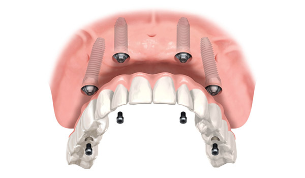 Animation von einem zahnlosen Kiefer, der mit vier Implantaten wieder mit einer vollständigen Zahnreihe ausgestattet wurde.