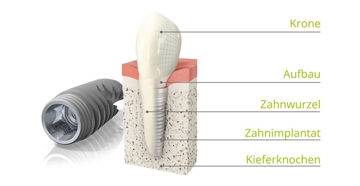 Modell eines Zahnimplantats mit den Beschriftungen Krone, Aufbau, Zahnwurzel, Zahnimplantat und Kieferknochen